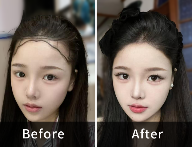 Kiana 2400 Grafts