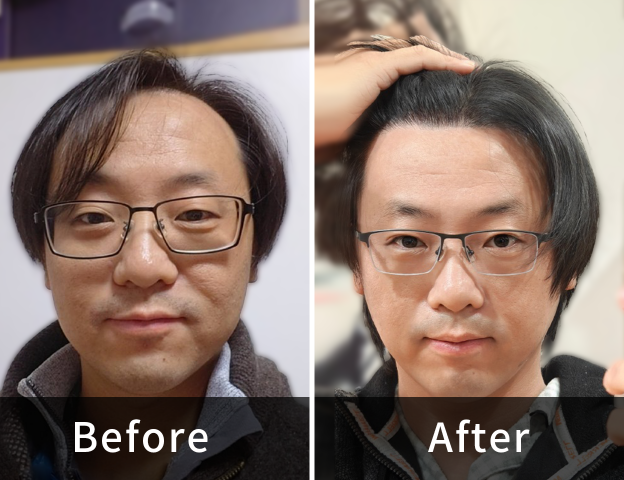 Li Quan 4000 Grafts